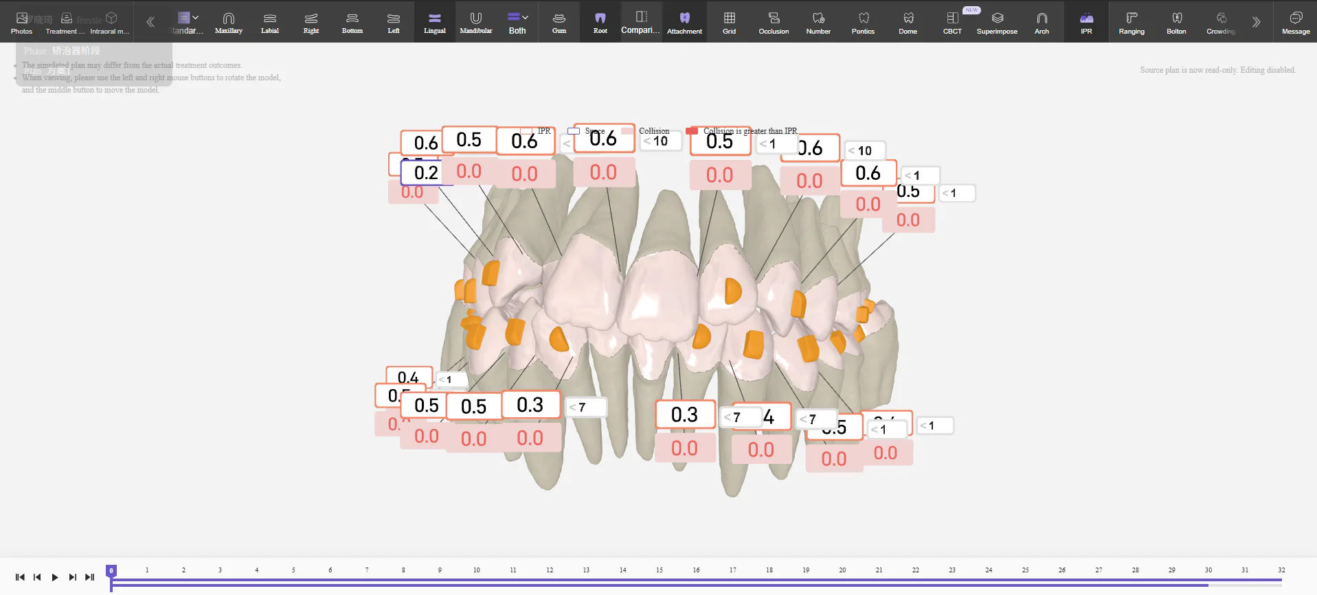 Best Smile Tech’s AI clear aligner design software platform